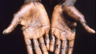 Dieses Bild aus dem Jahr 1997 entstand während einer Untersuchung eines Affenpockenausbruchs in der Demokratischen Republik Kongo (DRC), dem früheren Zaire.