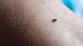 Bettwanzen ernähren sich von menschlichem Blut, sind aber harmlos.