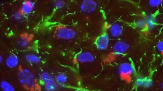 Der Kampf gegen die heimtückische Alzheimer-Krankheit verzeichnet weitere Erfolge.