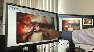 Deutlich in der starken Vergrößerung zu erkennen: Aneurysma mit Verkalkungen und roter Entzündung.
