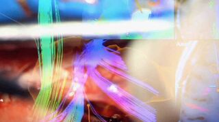 So sieht Nima Etminan die Operationsstelle durchs Mikroskop. Die digitale Technologie zeigt ihm lila, grün und blau an, wo die Nervenbahnen verlaufen, die er nicht verletzen darf. So gelingt die vollständige Entfernung von Hirntumoren.