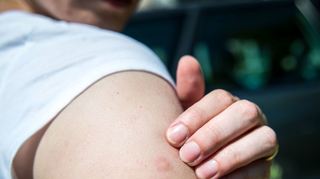 Mückenstiche sollte man nicht aufkratzen. Die Wunde könnte sich sonst entzünden.