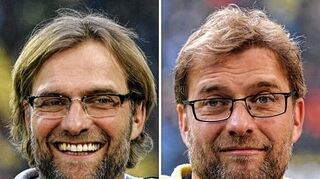 <p>Jürgen Klopp vor (links) und nach der Haartransplantation.</p>