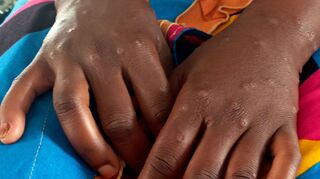 Mpox ist vor allem für kleine Kinder und immungeschwächte Menschen gefährlich (Archivbild)