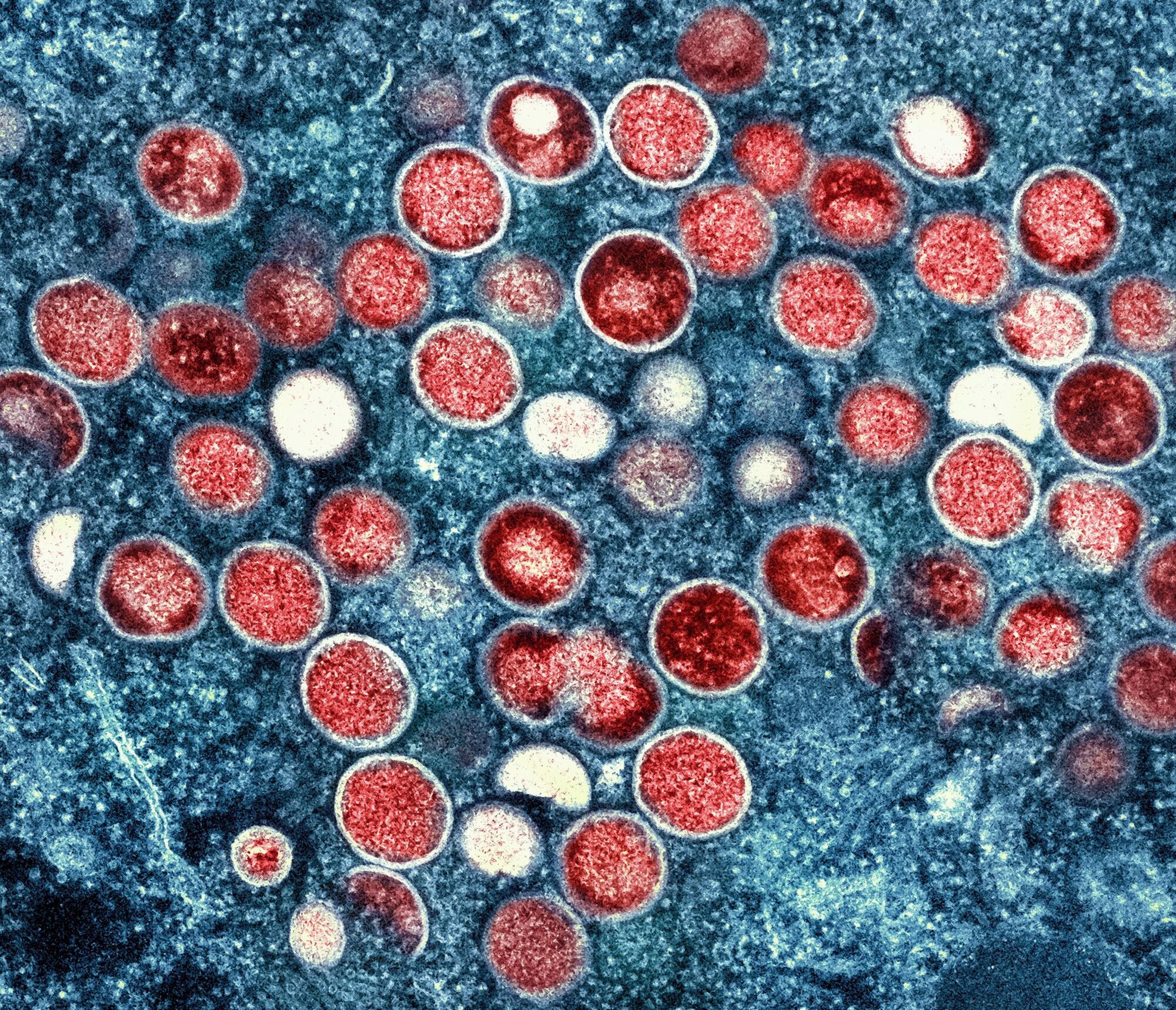 Mpox weitet sich in Berlin auf weitere Personengruppen aus